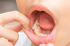 Crowded, misplaced or blocked-out teeth Crowded, misplaced or blocked-out teeth