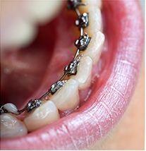 Lingual Braces